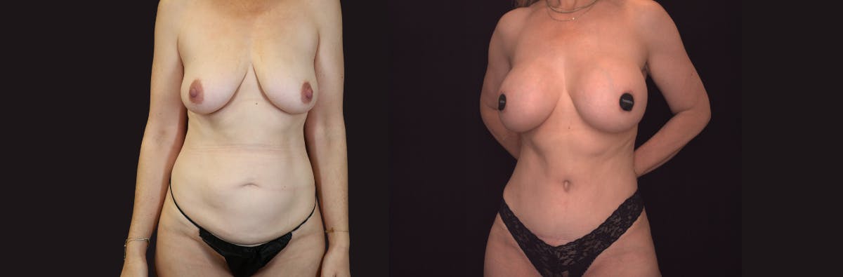 Mommy Makeover Before & After Gallery - Patient 294077 - Image 1