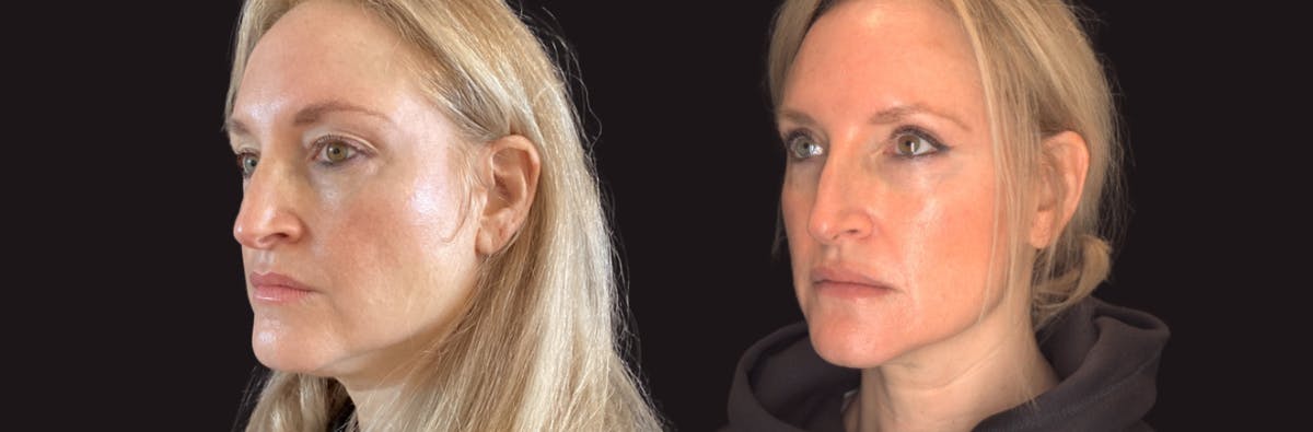 Blepharoplasty Before & After Gallery - Patient 283919 - Image 2