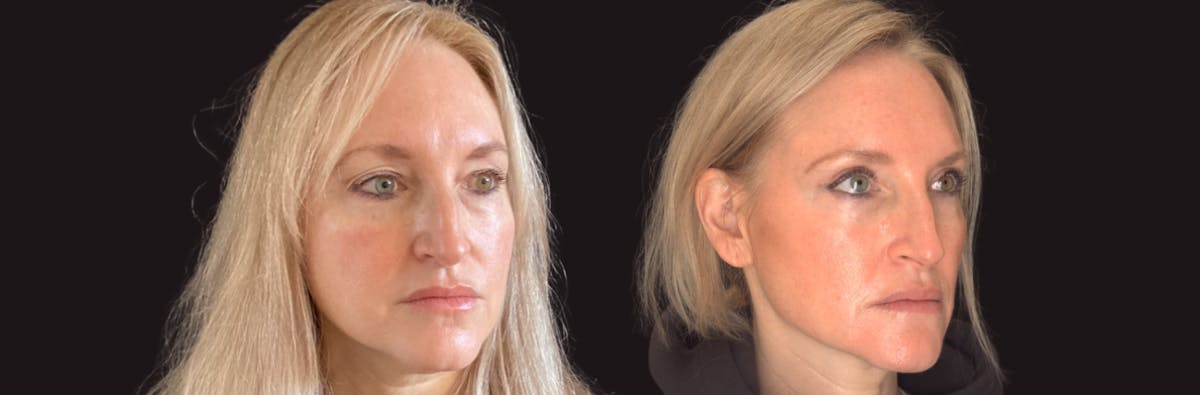 Blepharoplasty Before & After Gallery - Patient 283919 - Image 3