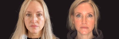 Blepharoplasty Before & After Gallery - Patient 283919 - Image 1
