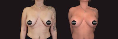 Breast Lift Before & After Gallery - Patient 395923 - Image 1