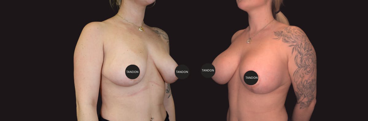 Breast Lift Before & After Gallery - Patient 395923 - Image 2
