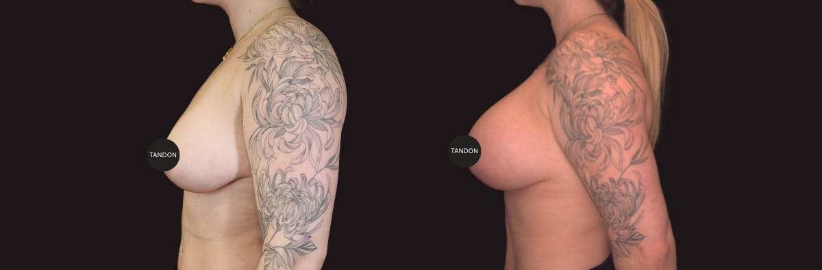 Breast Lift Before & After Gallery - Patient 395923 - Image 3