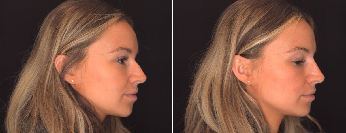 Non Surgical Rhinoplasty Before & After Gallery - Patient 263491 - Image 3