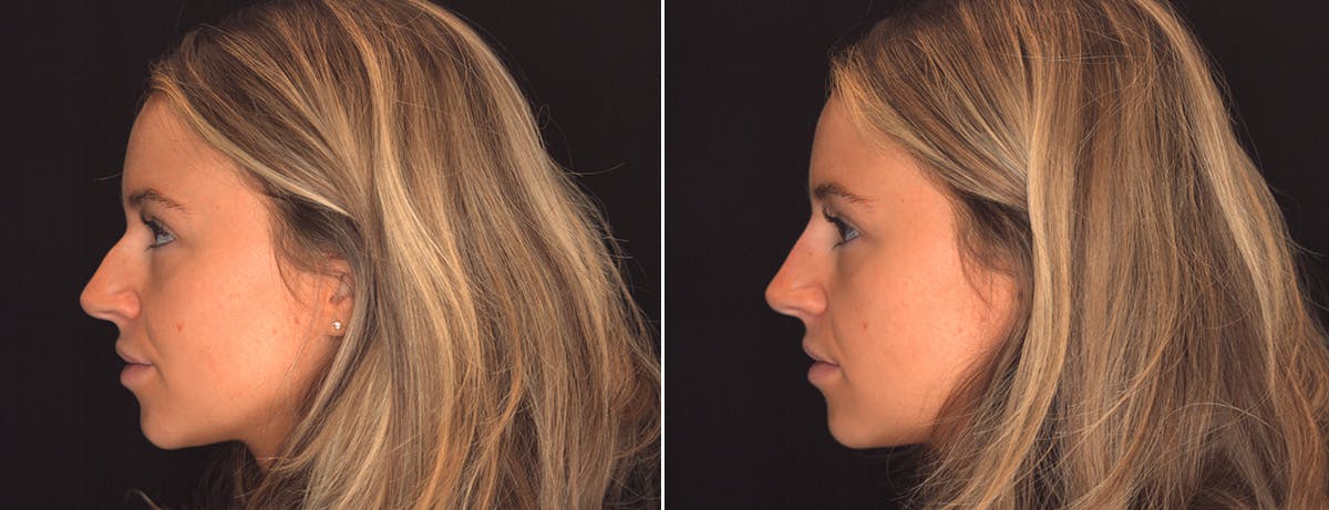Non Surgical Rhinoplasty Before & After Gallery - Patient 263491 - Image 4