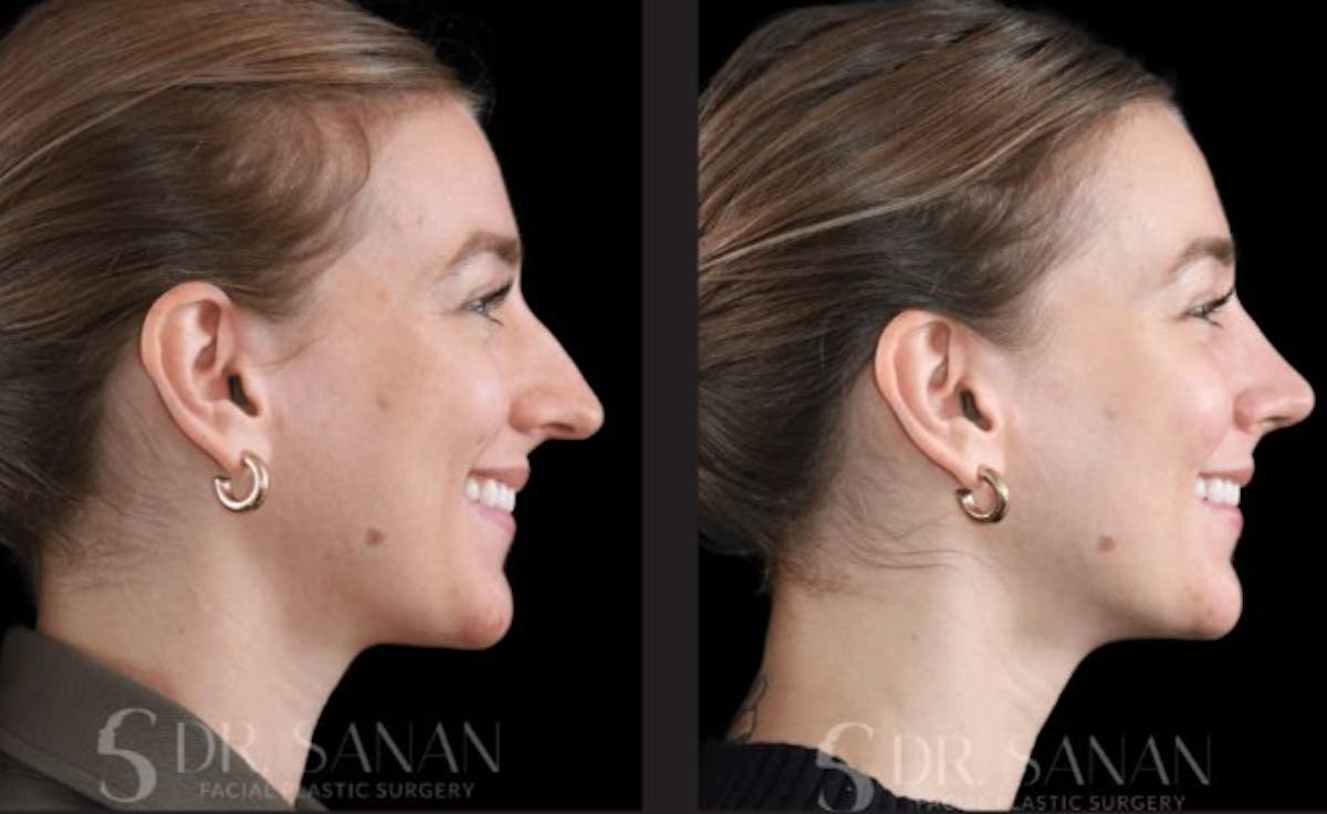Rhinoplasty Before & After Gallery - Patient 213549 - Image 1