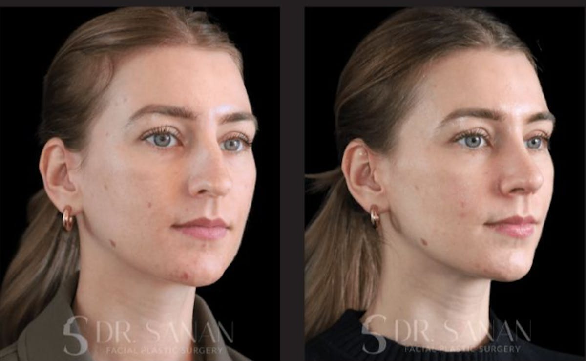 Rhinoplasty Before & After Gallery - Patient 213549 - Image 3