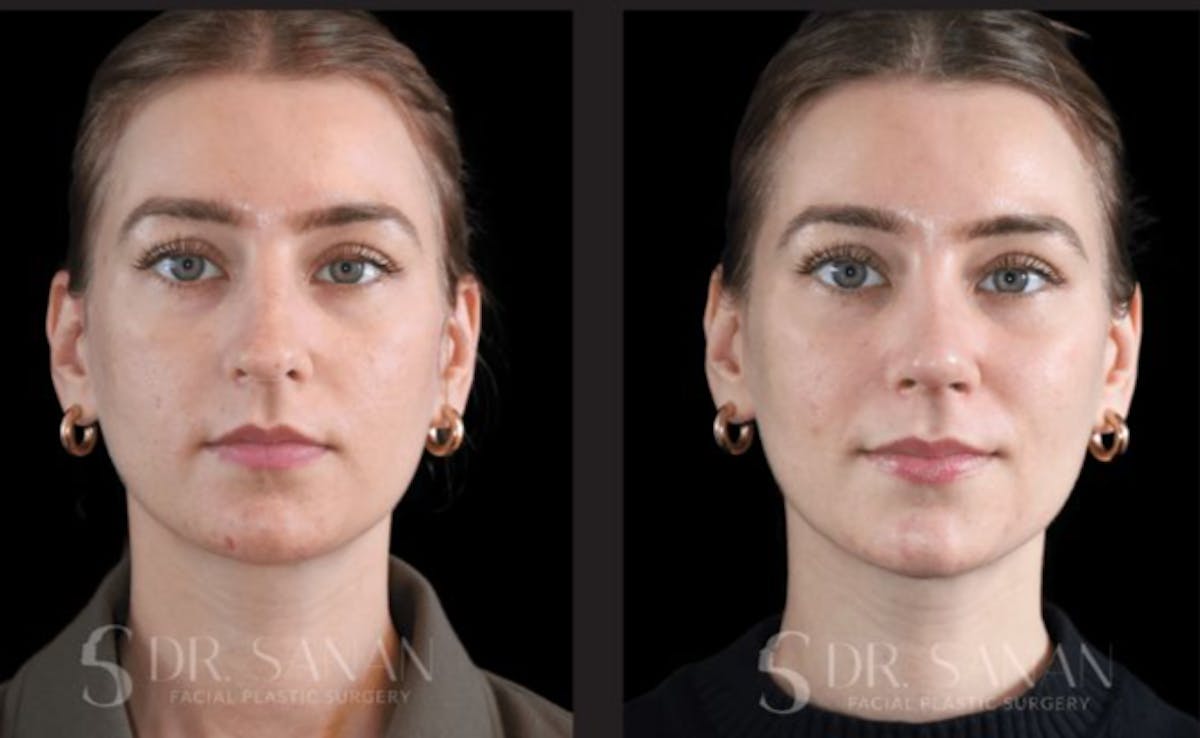 Rhinoplasty Before & After Gallery - Patient 213549 - Image 4