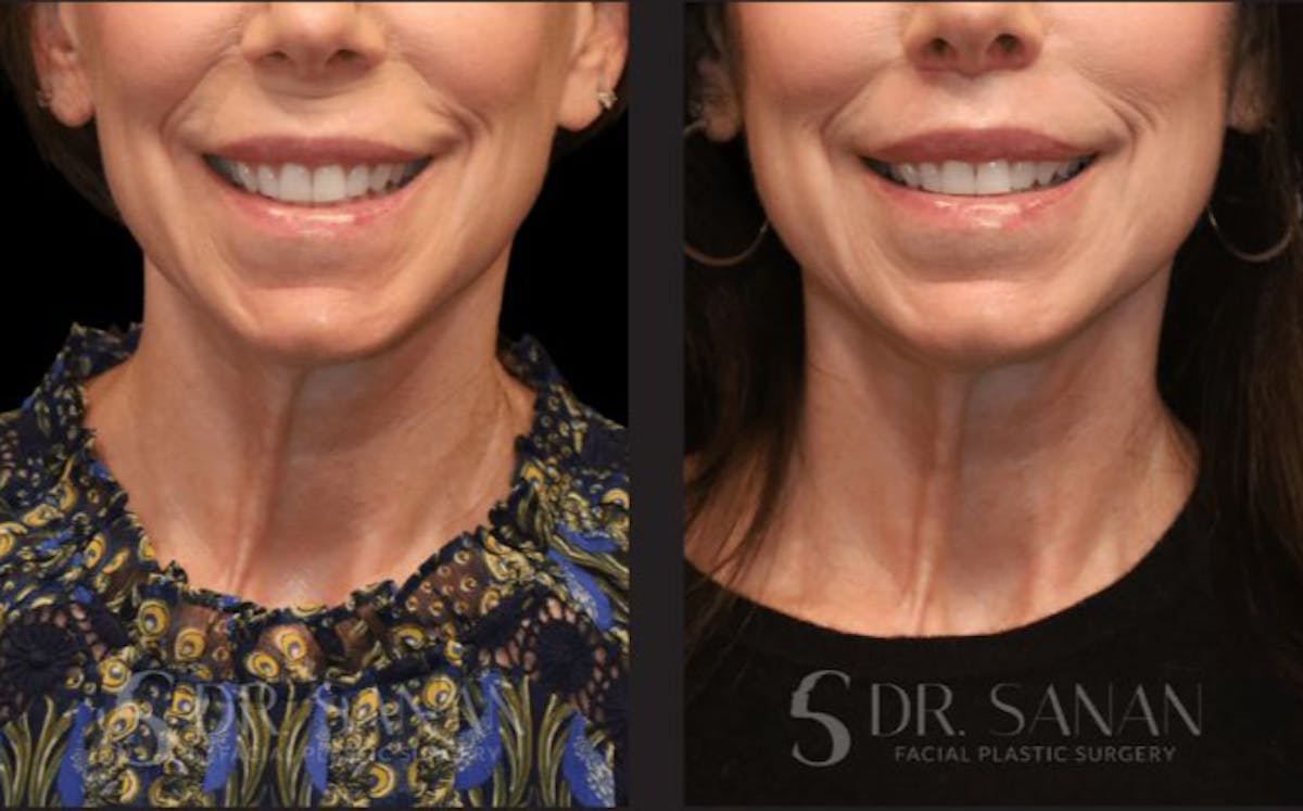 Lip Lift Before & After Gallery - Patient 134342 - Image 1