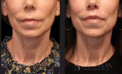 Lip Lift Before & After Gallery - Patient 134342 - Image 1