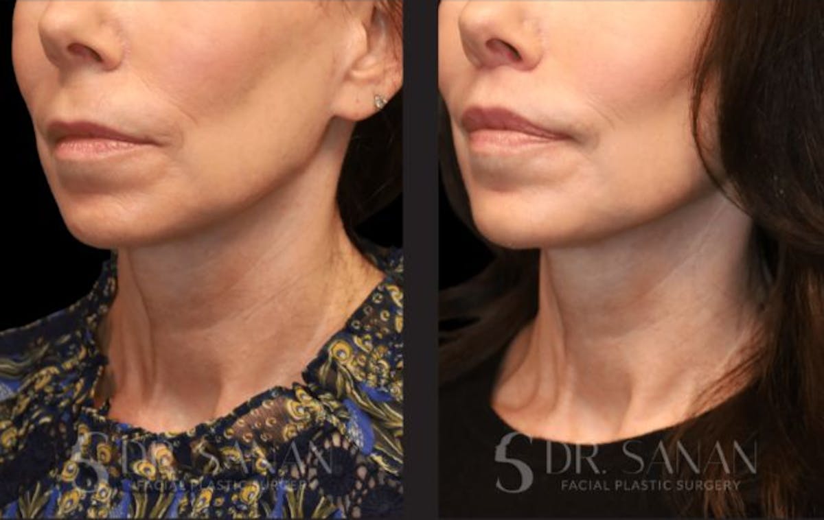 Lip Lift Before & After Gallery - Patient 134342 - Image 4