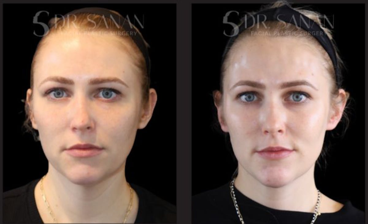 Chin Augmentation Before & After Gallery - Patient 272790 - Image 4