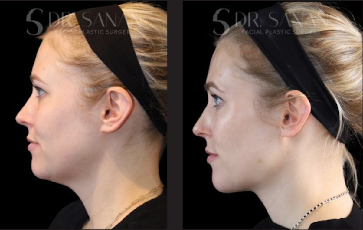 Chin Augmentation Before & After Gallery - Patient 272790 - Image 3