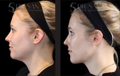 Neck Lift Before & After Gallery - Patient 171758 - Image 1