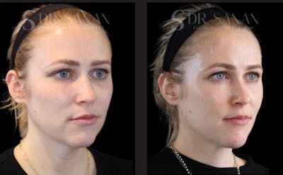 Neck Lift Before & After Gallery - Patient 171758 - Image 1