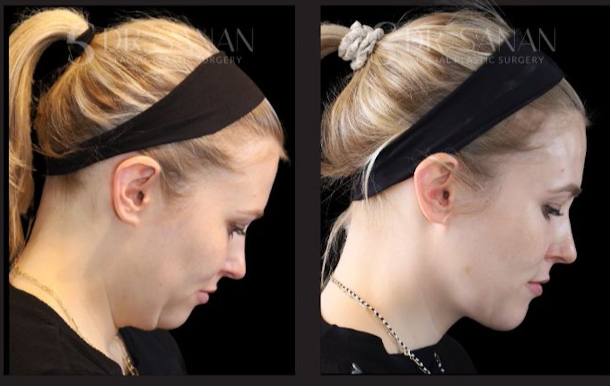 Chin Augmentation Before & After Gallery - Patient 272790 - Image 2