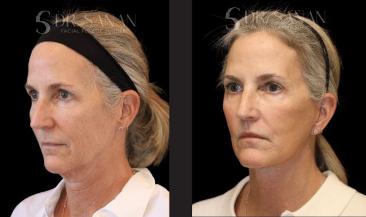 Neck Lift Before & After Gallery - Patient 298295 - Image 3