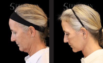 Neck Lift Before & After Gallery - Patient 298295 - Image 1