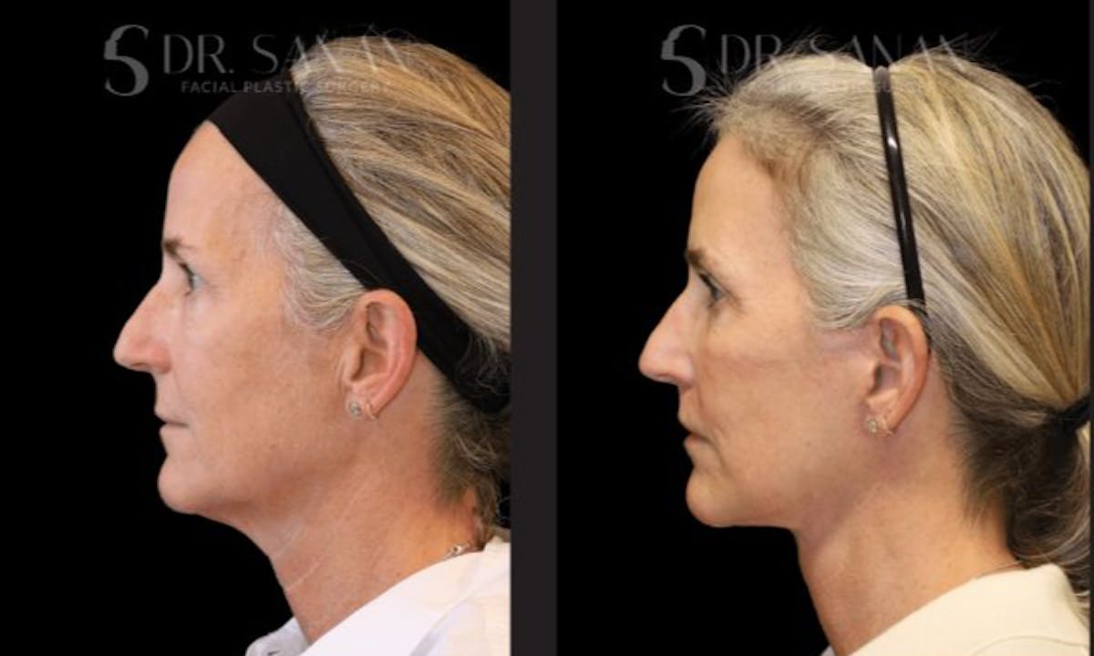 Neck Lift Before & After Gallery - Patient 298295 - Image 4