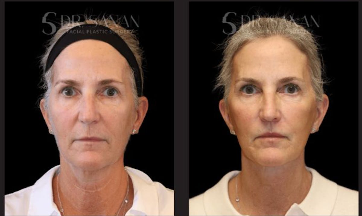 Neck Lift Before & After Gallery - Patient 298295 - Image 2