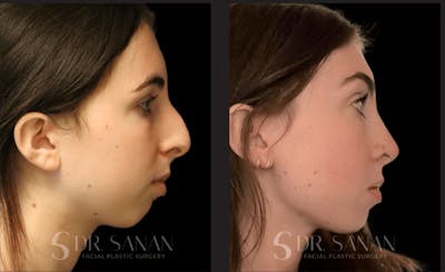 Rhinoplasty Before & After Gallery - Patient 426808 - Image 1