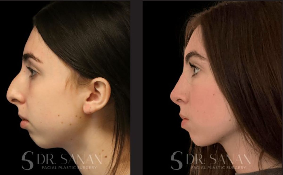 Rhinoplasty Before & After Gallery - Patient 426808 - Image 2