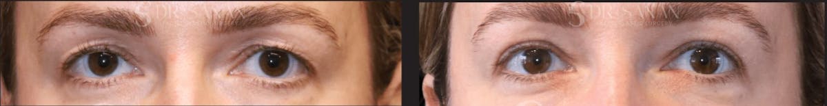 Blepharoplasty Before & After Gallery - Patient 408656 - Image 1