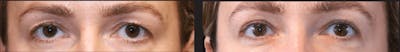 Blepharoplasty Before & After Gallery - Patient 408656 - Image 1