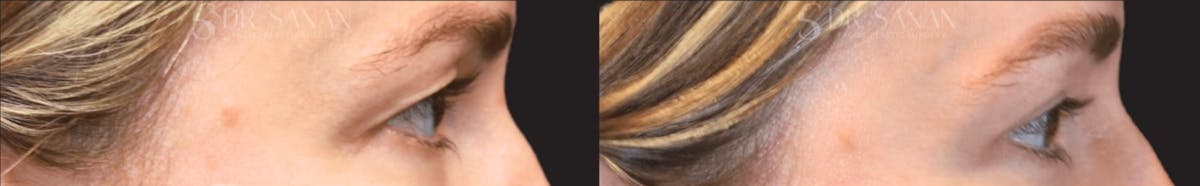 Blepharoplasty Before & After Gallery - Patient 408656 - Image 3