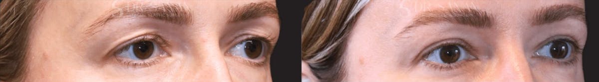 Blepharoplasty Before & After Gallery - Patient 408656 - Image 2