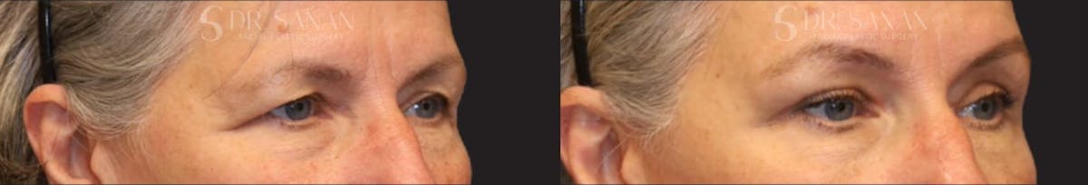 Blepharoplasty Before & After Gallery - Patient 270446 - Image 1