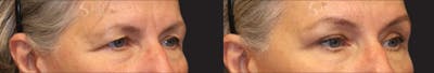 Blepharoplasty Before & After Gallery - Patient 270446 - Image 1
