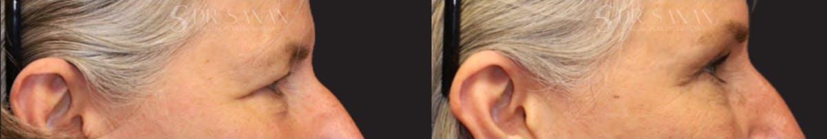Blepharoplasty Before & After Gallery - Patient 270446 - Image 3