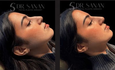 Non Surgical Rhinoplasty Before & After Gallery - Patient 262490 - Image 1