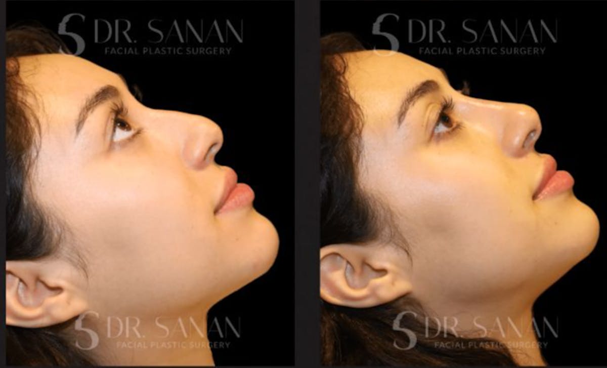 Non Surgical Rhinoplasty Before & After Gallery - Patient 262490 - Image 2