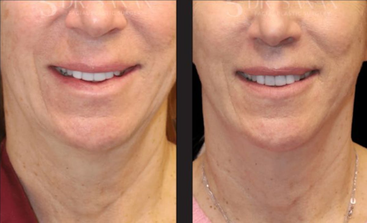 Lip Lift Before & After Gallery - Patient 246414 - Image 1