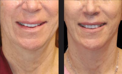 Lip Lift Before & After Gallery - Patient 246414 - Image 1