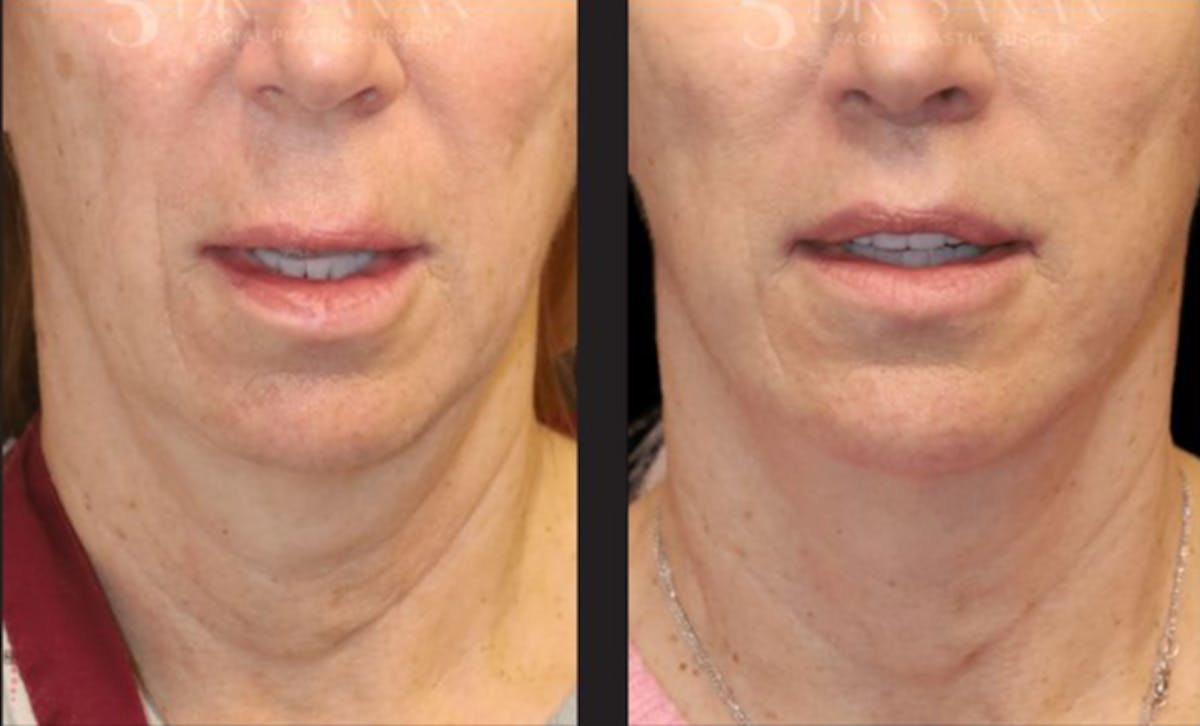 Lip Lift Before & After Gallery - Patient 246414 - Image 3