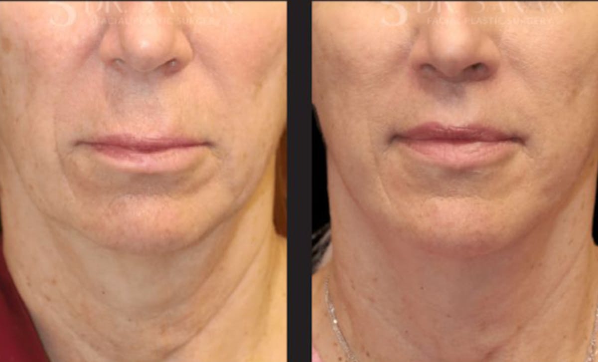 Lip Lift Before & After Gallery - Patient 246414 - Image 2