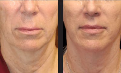Lip Lift Before & After Gallery - Patient 246414 - Image 1