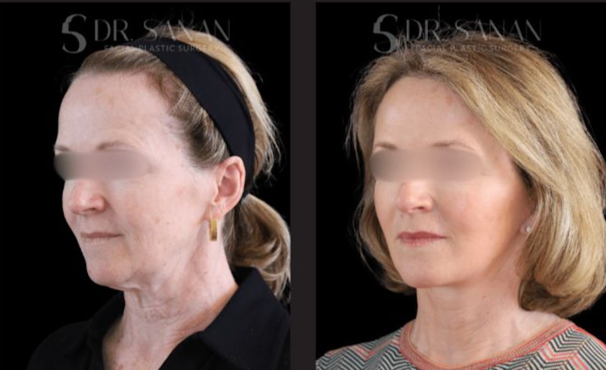 Facelift Before & After Gallery - Patient 416226 - Image 2
