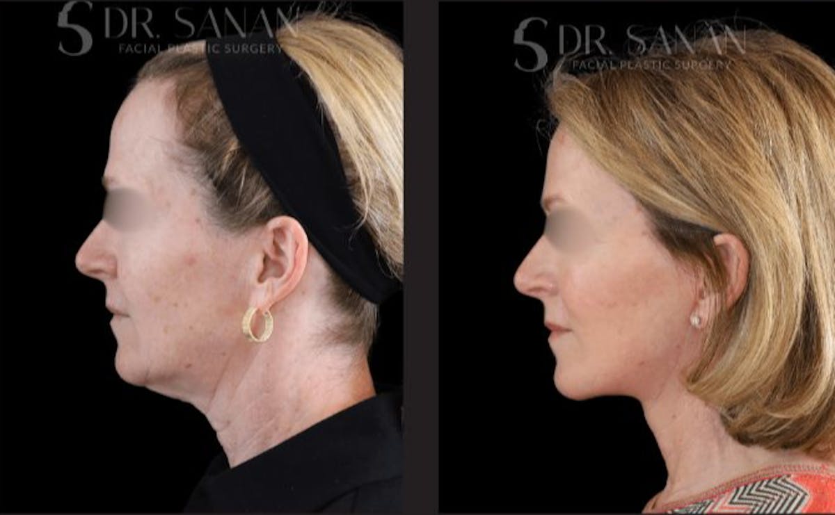 Facelift Before & After Gallery - Patient 416226 - Image 3