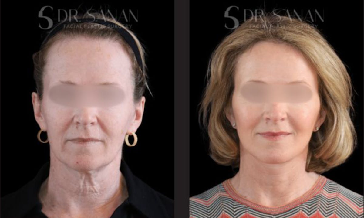 Facelift Before & After Gallery - Patient 416226 - Image 1