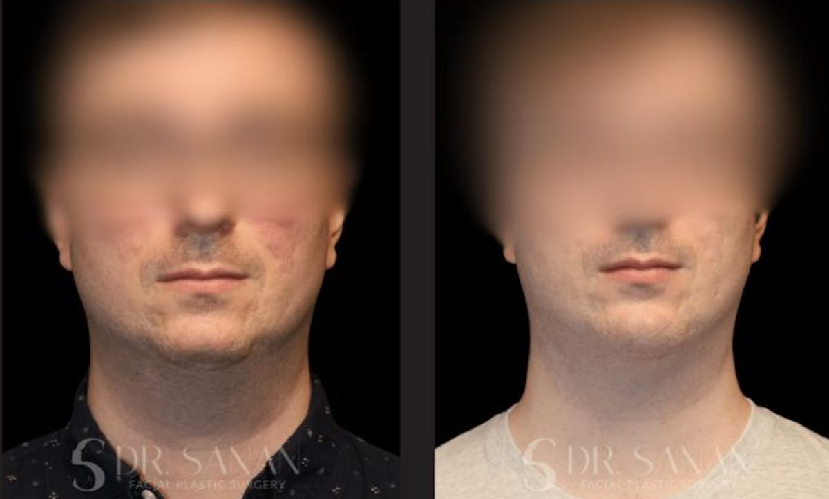 Chin Augmentation Before & After Gallery - Patient 190308 - Image 3