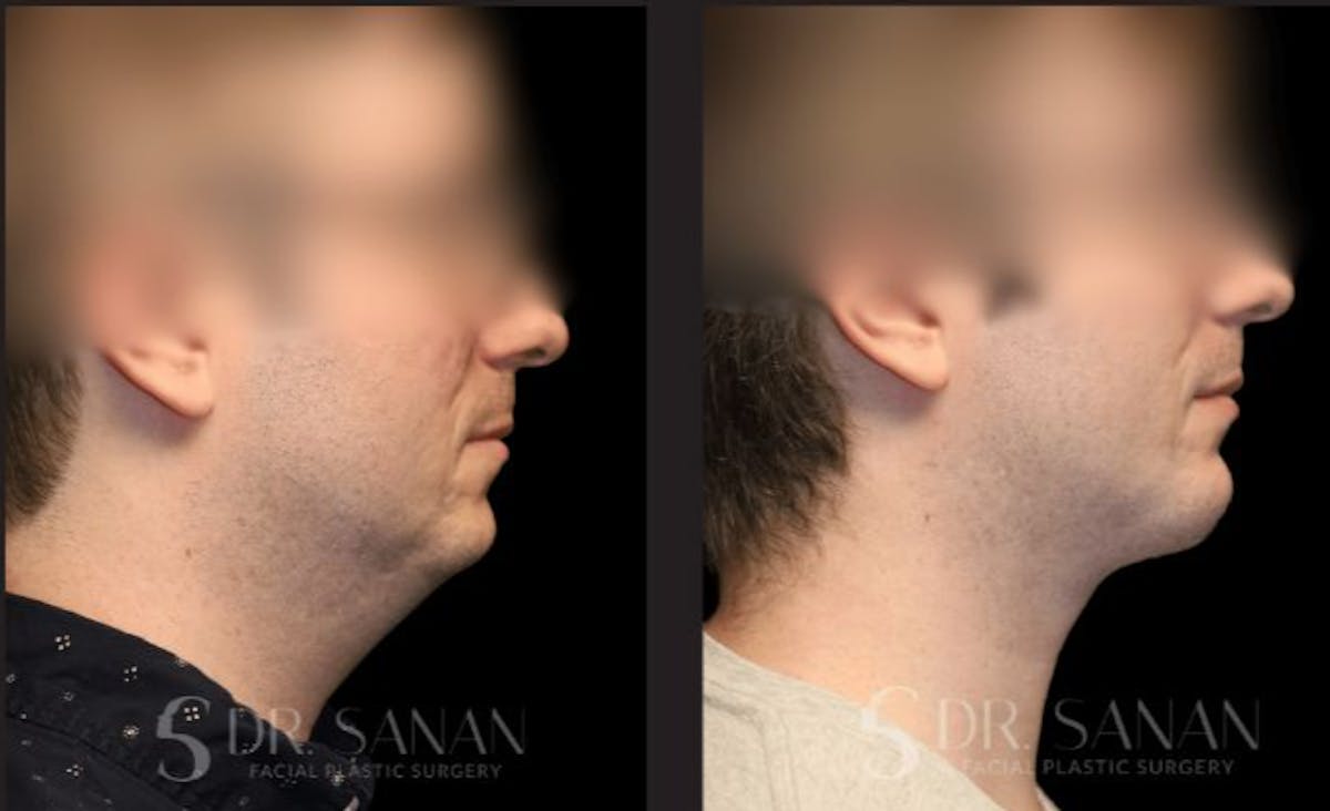 Chin Augmentation Before & After Gallery - Patient 190308 - Image 2