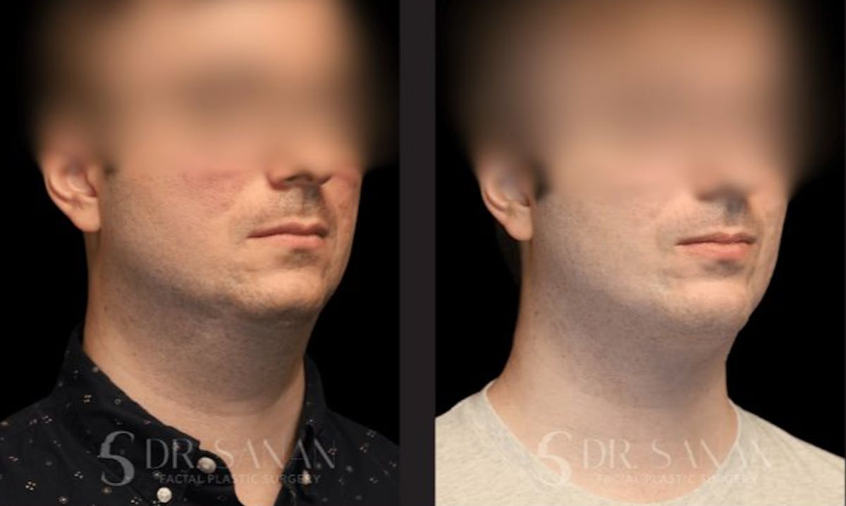 Chin Augmentation Before & After Gallery - Patient 190308 - Image 4