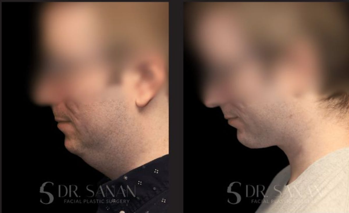 Chin Augmentation Before & After Gallery - Patient 190308 - Image 1