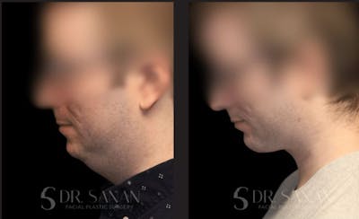 Neck Lift Before & After Gallery - Patient 334683 - Image 1
