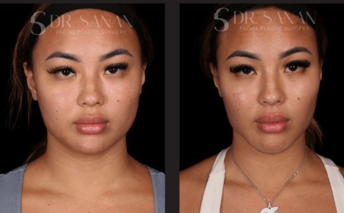 Neck Lift Before & After Gallery - Patient 893334 - Image 3