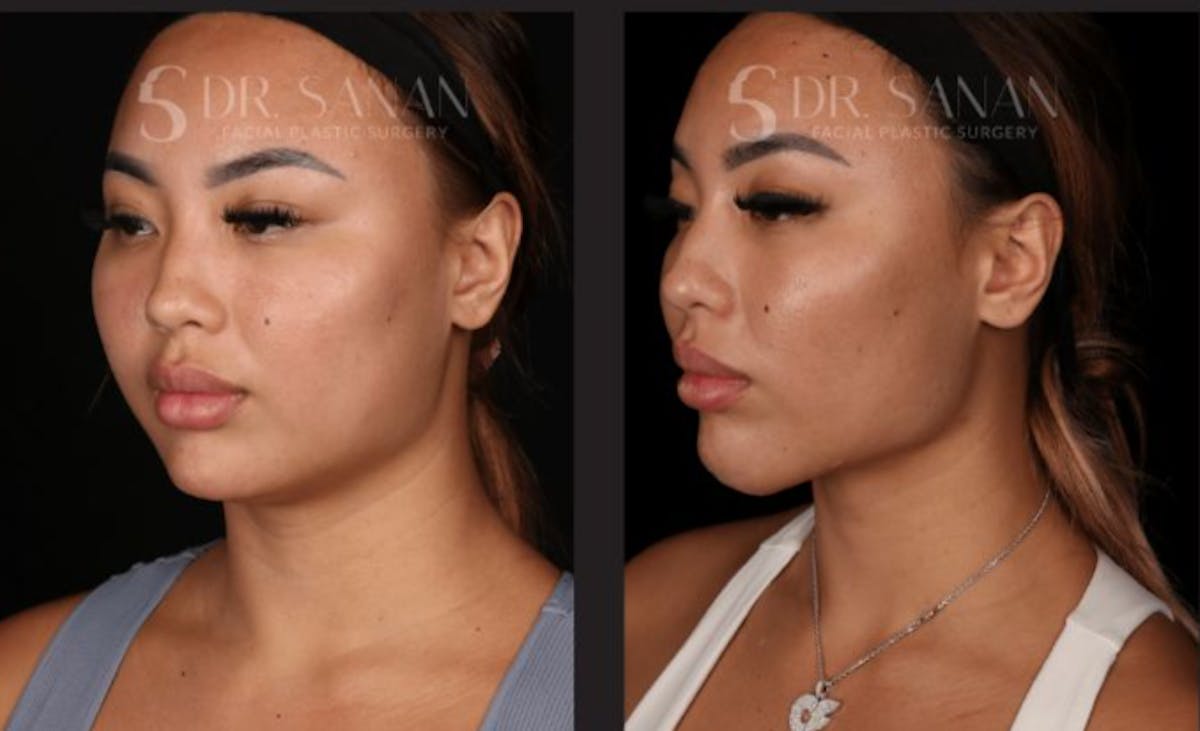 Neck Lift Before & After Gallery - Patient 893334 - Image 2